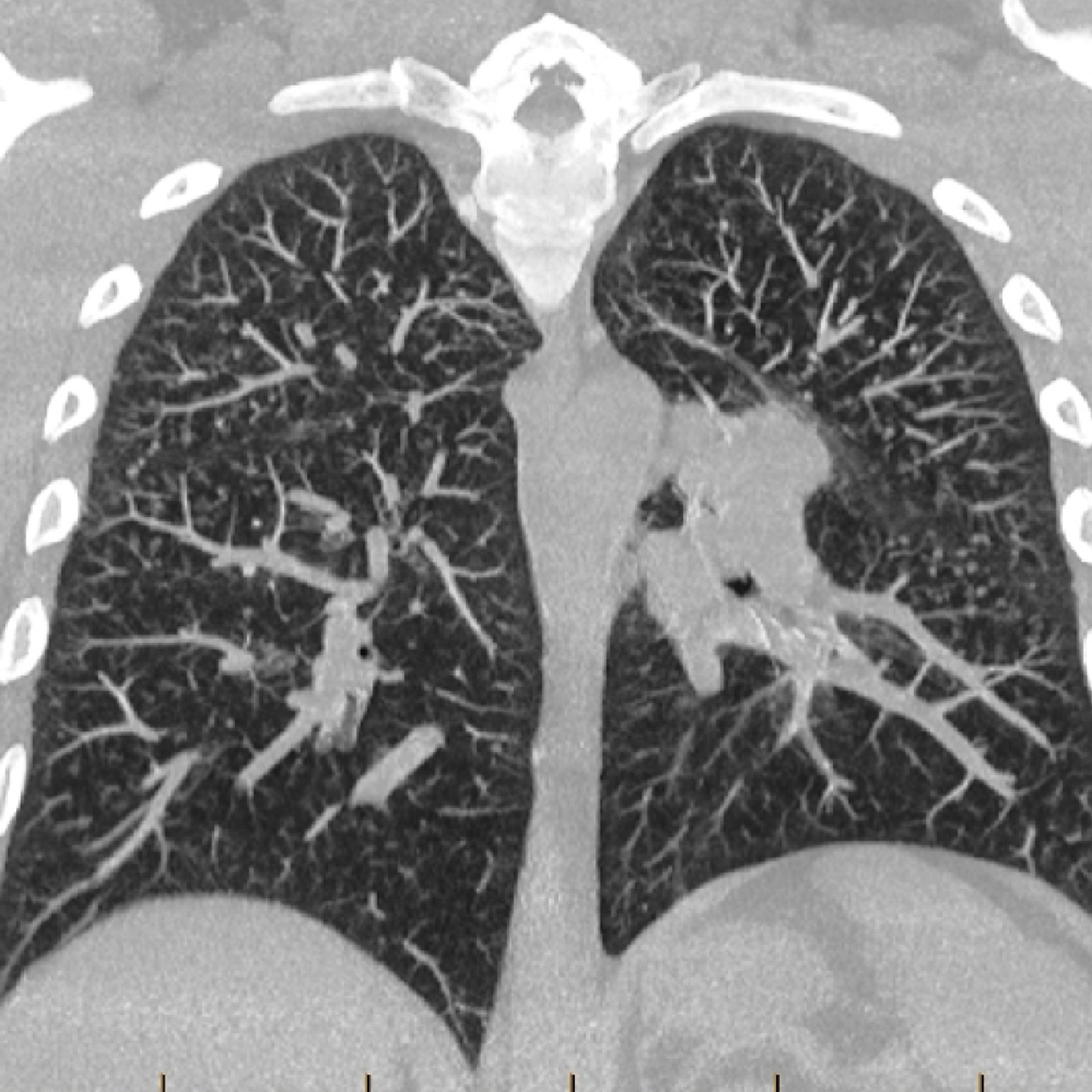 MRI Image of lung fibres from front of chest.